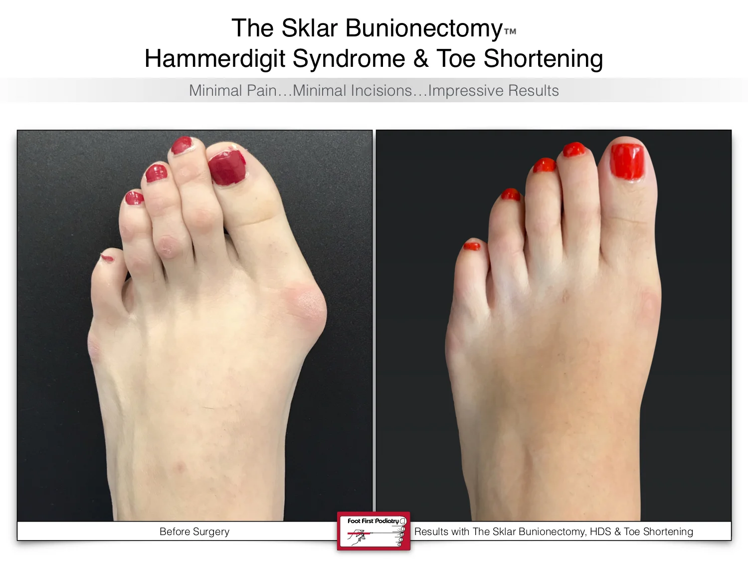 Bunions — Foot First Podiatry Centers